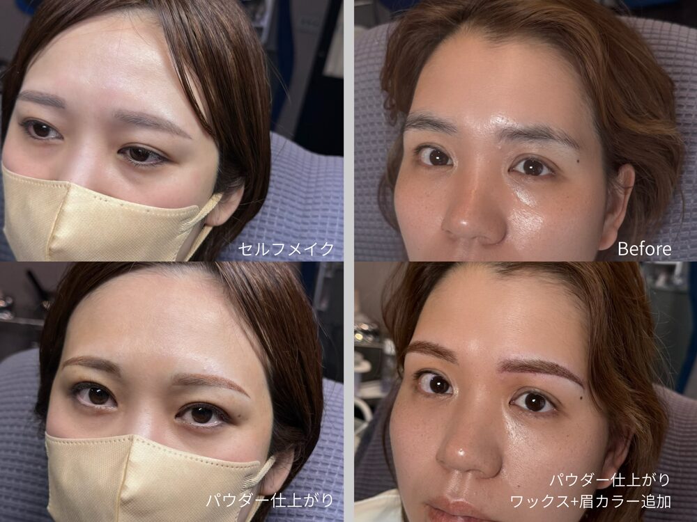 施術イメージ