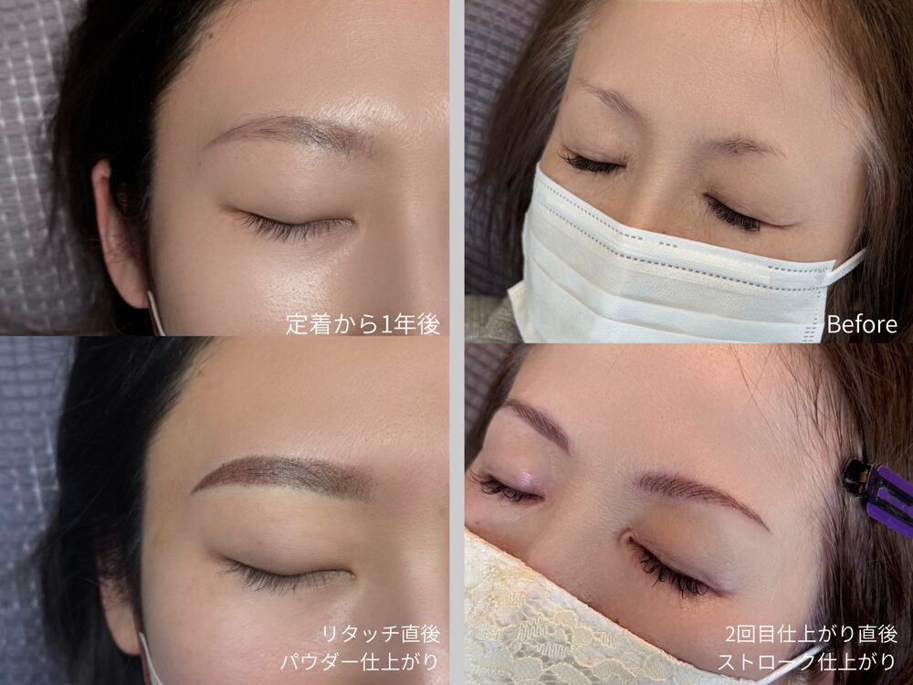 施術イメージ